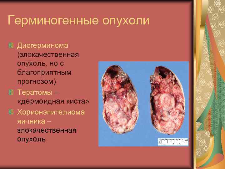 Герминогенные опухоли Дисгерминома (злокачественная опухоль, но с благоприятным прогнозом) Тератомы – «дермоидная киста» Хорионэпителиома