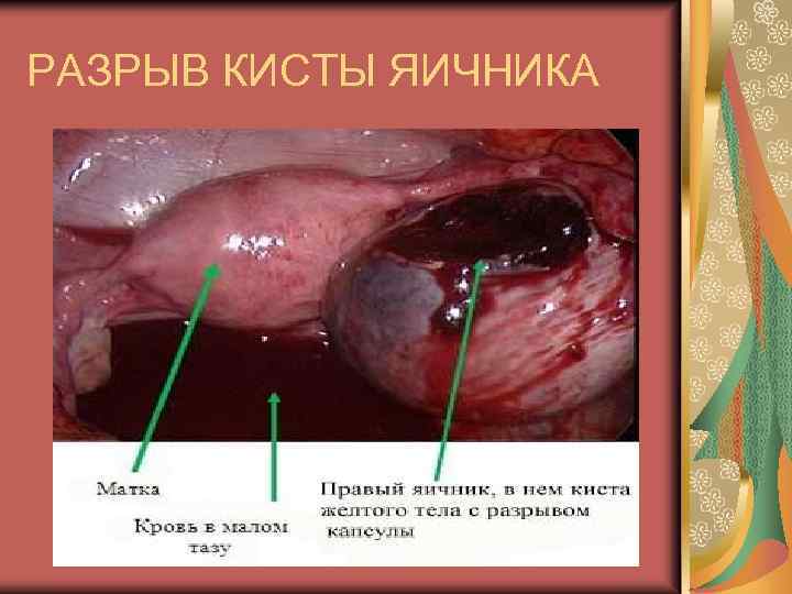 РАЗРЫВ КИСТЫ ЯИЧНИКА 