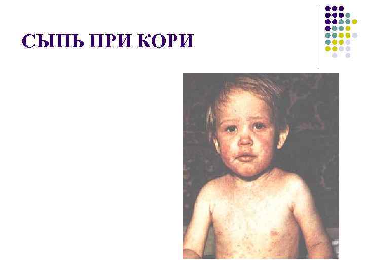 СЫПЬ ПРИ КОРИ 