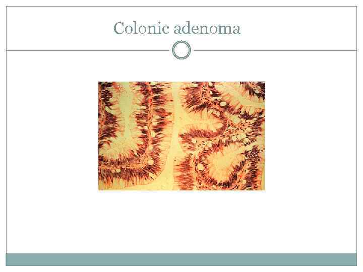 Colonic adenoma 