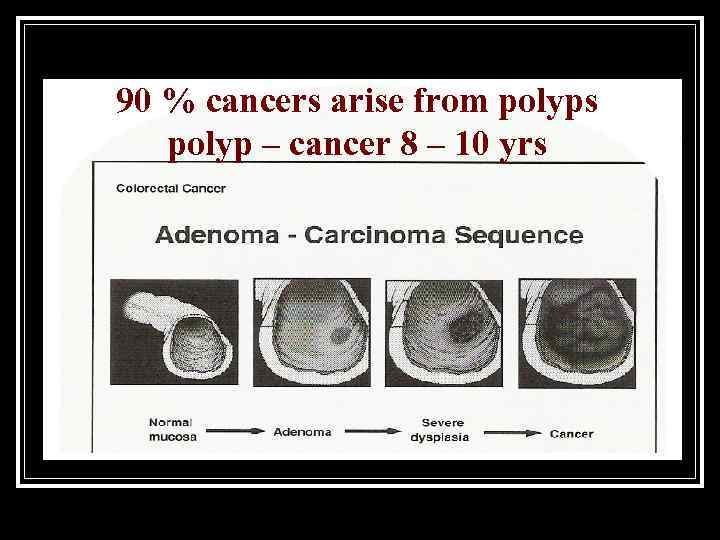 90 % cancers arise from polyps polyp – cancer 8 – 10 yrs 