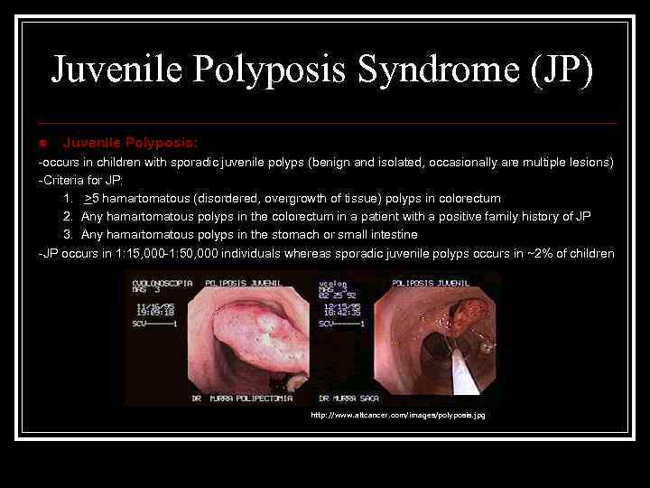 Juvenile Polyposis Syndrome (JP) n Juvenile Polyposis: -occurs in children with sporadic juvenile polyps