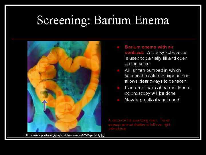 Screening: Barium Enema n n Barium enema with air contrast: A chalky substance is