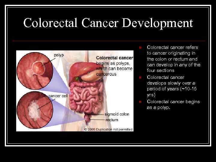 Colorectal Cancer Development n n n Colorectal cancer refers to cancer originating in the