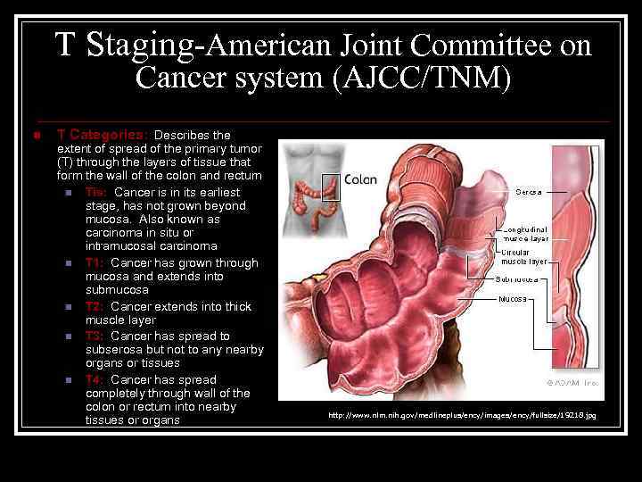 T Staging-American Joint Committee on Cancer system (AJCC/TNM) n T Categories: Describes the extent