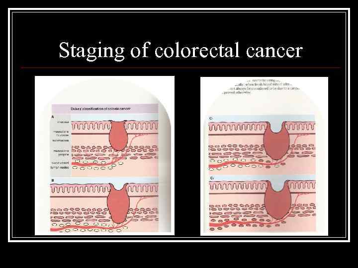 Staging of colorectal cancer 