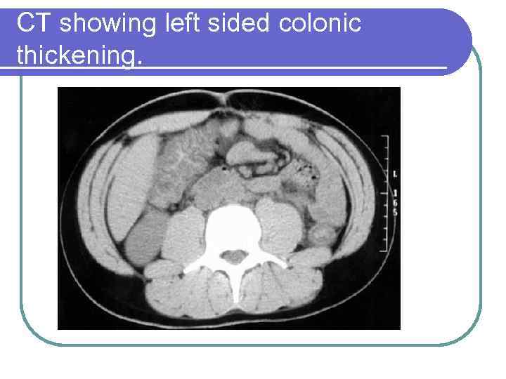 CT showing left sided colonic thickening. 