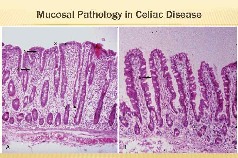 Mucosal Pathology in Celiac Disease 