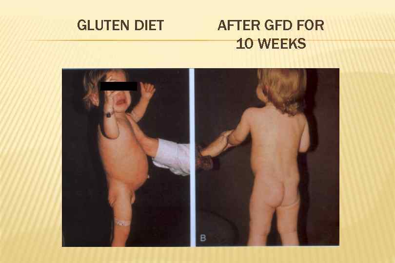 GLUTEN DIET AFTER GFD FOR 10 WEEKS 