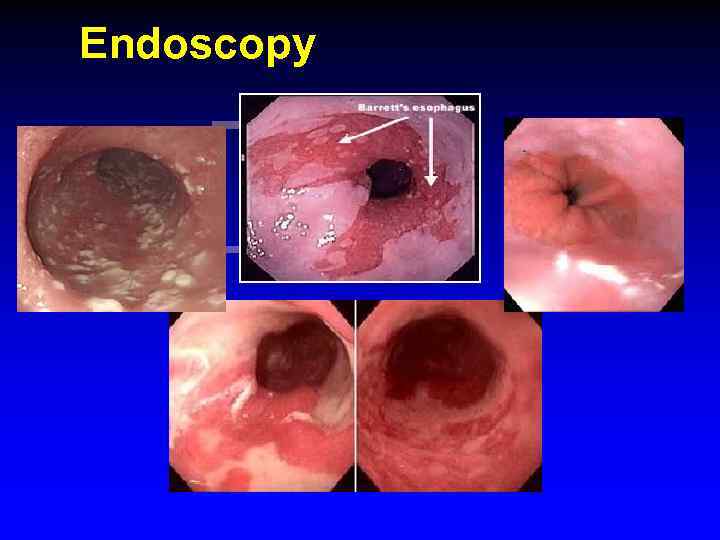Endoscopy 