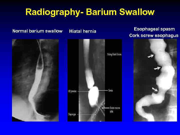 barium swallow test