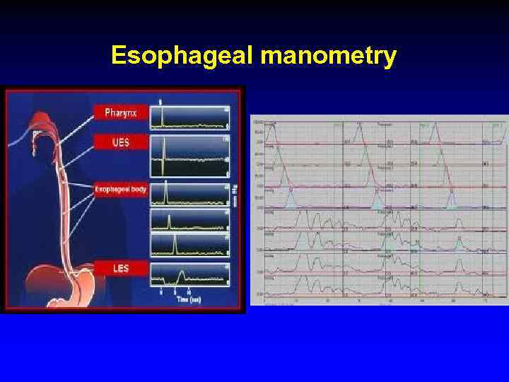 Esophageal manometry 