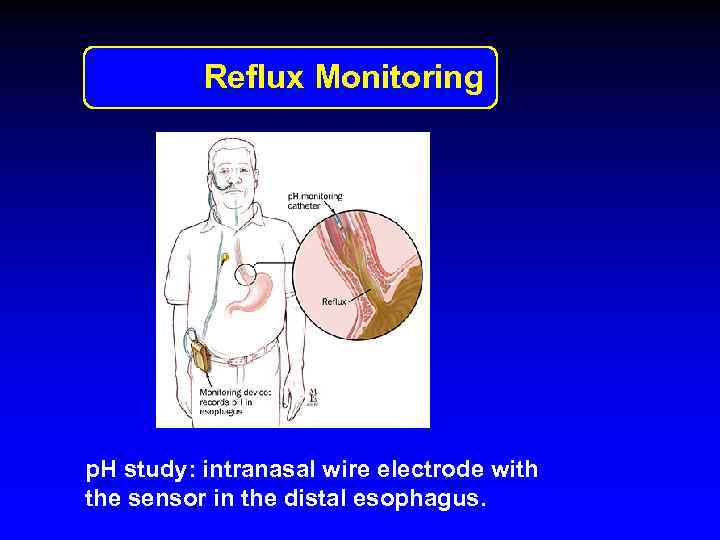 Reflux Monitoring p. H study: intranasal wire electrode with the sensor in the distal