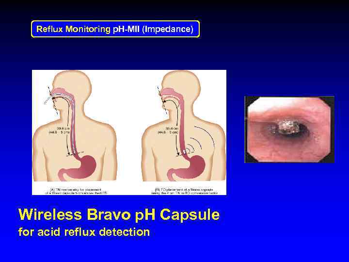 Reflux Monitoring p. H-MII (Impedance) Wireless Bravo p. H Capsule for acid reflux detection