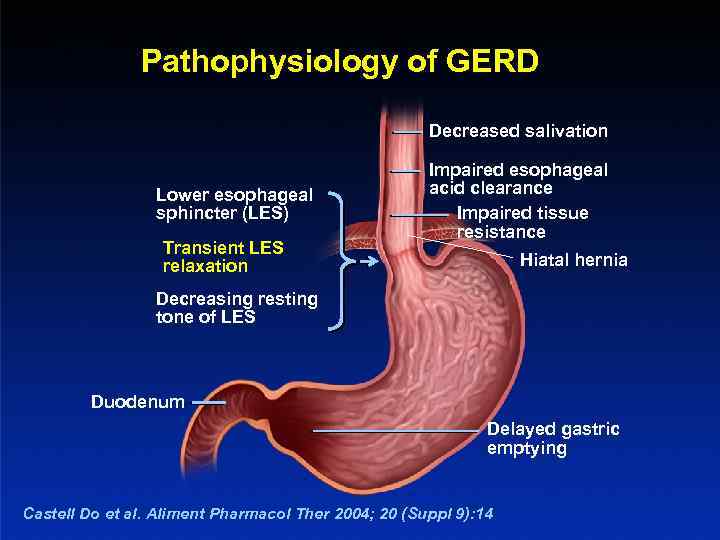 Pathophysiology of GERD Decreased salivation Lower esophageal sphincter (LES) Transient LES relaxation Impaired esophageal