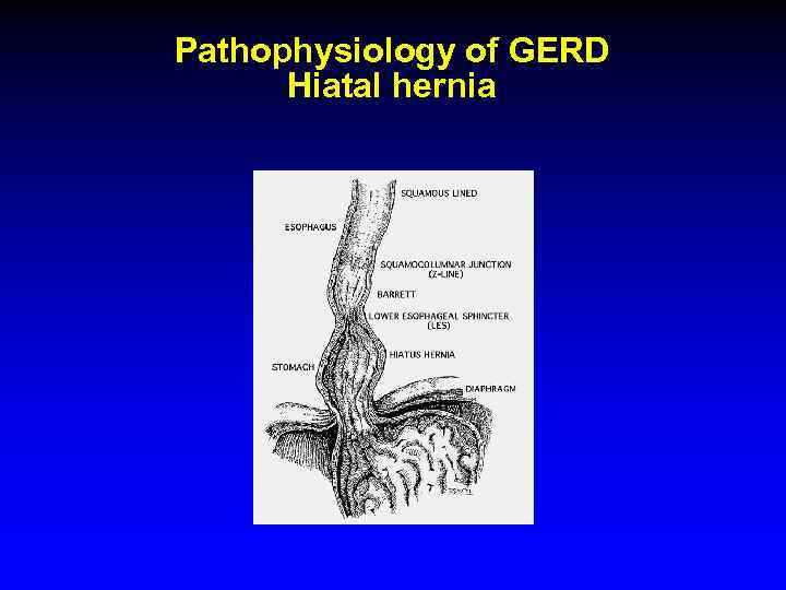 Pathophysiology of GERD Hiatal hernia 
