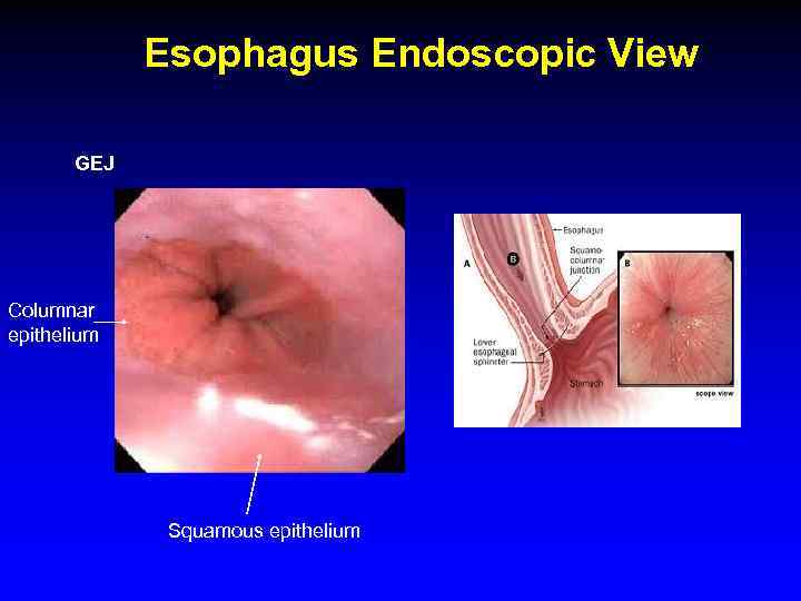 Esophagus Endoscopic View GEJ Columnar epithelium Squamous epithelium 