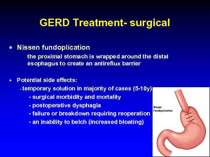 GERD Treatment- surgical · Nissen fundoplication the proximal stomach is wrapped around the distal