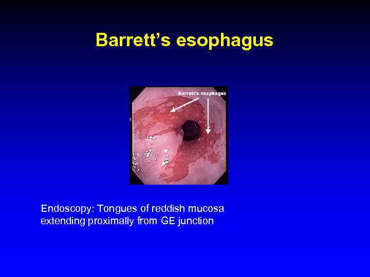 Barrett’s esophagus Endoscopy: Tongues of reddish mucosa extending proximally from GE junction 