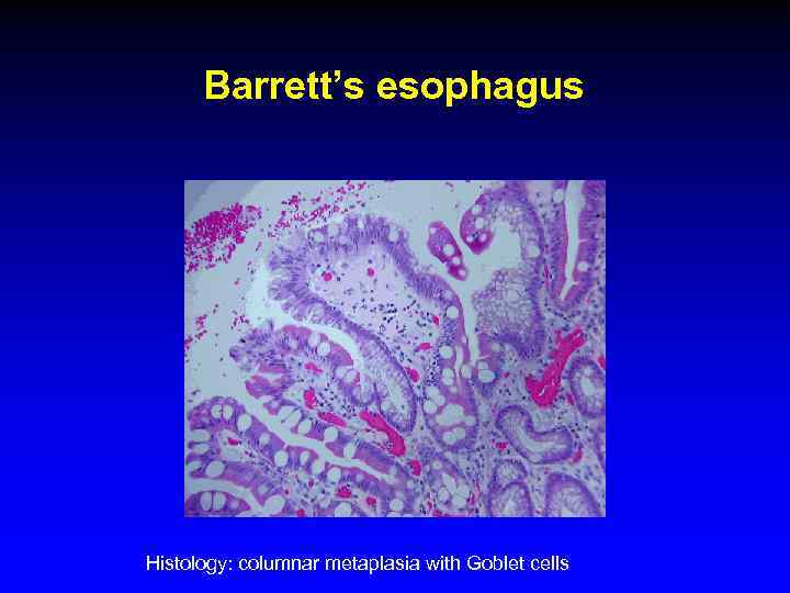 Barrett’s esophagus Histology: columnar metaplasia with Goblet cells 