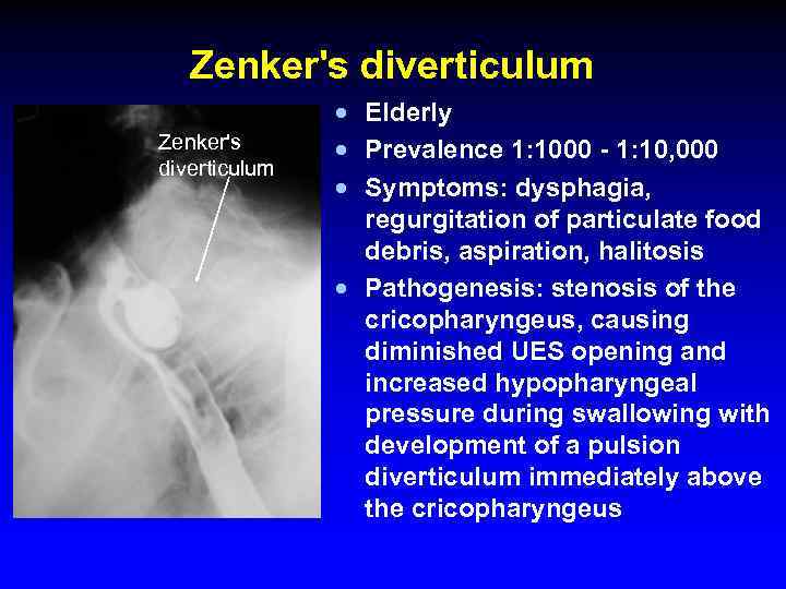 Zenker's diverticulum · Elderly · Prevalence 1: 1000 - 1: 10, 000 · Symptoms: