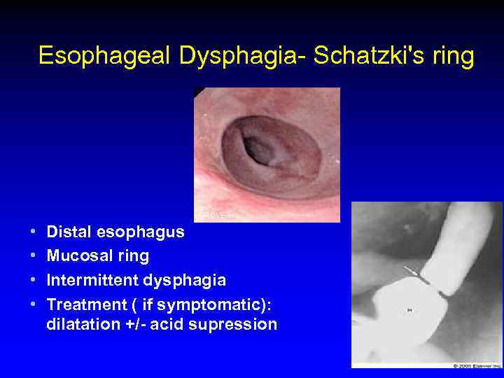 Esophageal Dysphagia- Schatzki's ring • • Distal esophagus Mucosal ring Intermittent dysphagia Treatment (