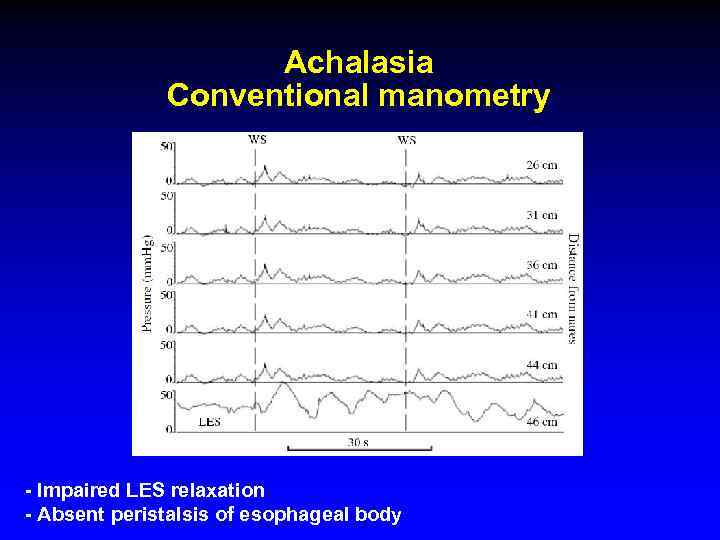 Achalasia Conventional manometry - Impaired LES relaxation - Absent peristalsis of esophageal body 