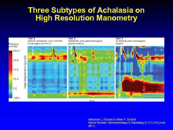 Three Subtypes of Achalasia on High Resolution Manometry Alexander J. Eckardt & Volker F.