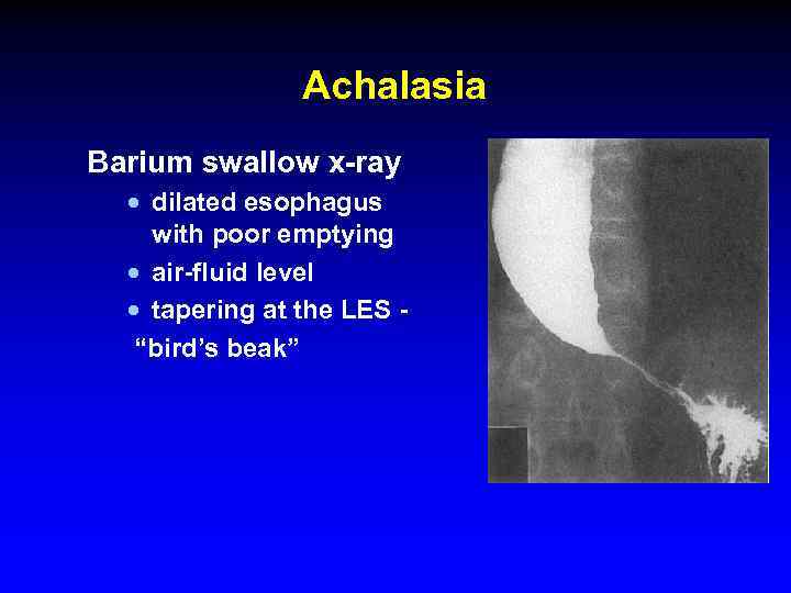 Achalasia Barium swallow x-ray · dilated esophagus with poor emptying · air-fluid level ·