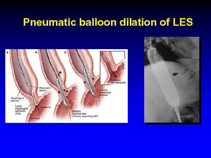 Pneumatic balloon dilation of LES 