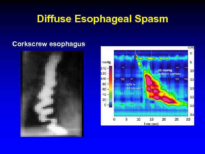 Diffuse Esophageal Spasm Corkscrew esophagus 
