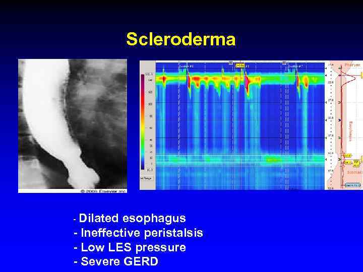 Scleroderma - Dilated esophagus - Ineffective peristalsis - Low LES pressure - Severe GERD
