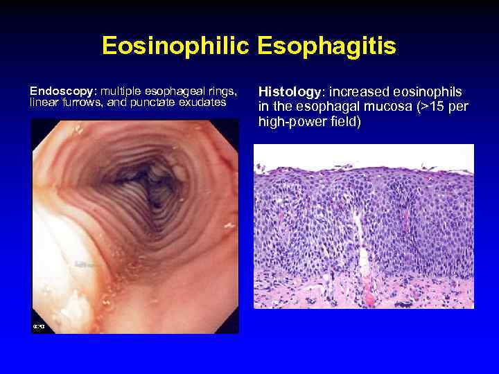 Eosinophilic Esophagitis Endoscopy: multiple esophageal rings, linear furrows, and punctate exudates Histology: increased eosinophils