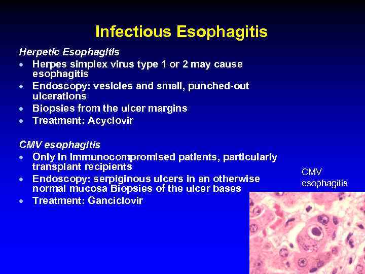 Infectious Esophagitis Herpetic Esophagitis · Herpes simplex virus type 1 or 2 may cause