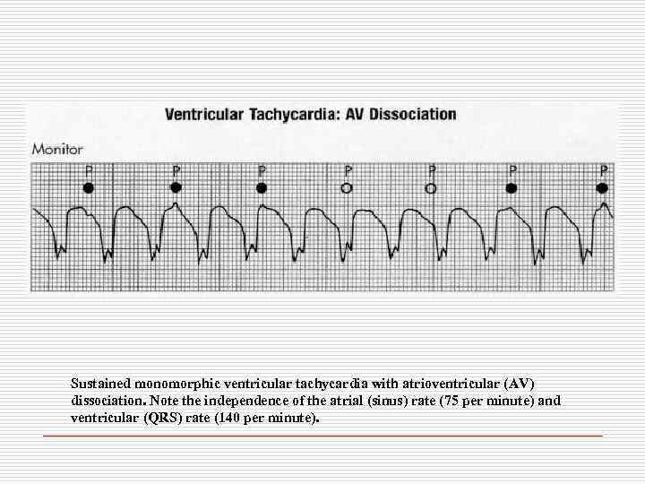 Sustained monomorphic ventricular tachycardia with atrioventricular (AV) dissociation. Note the independence of the atrial