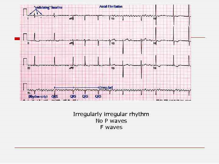 Irregularly irregular rhythm No P waves F waves 
