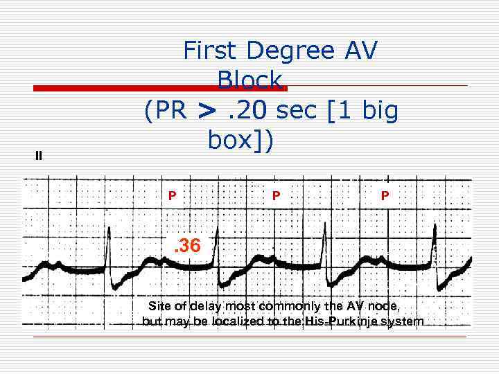 II First Degree AV Block (PR >. 20 sec [1 big box]) P P
