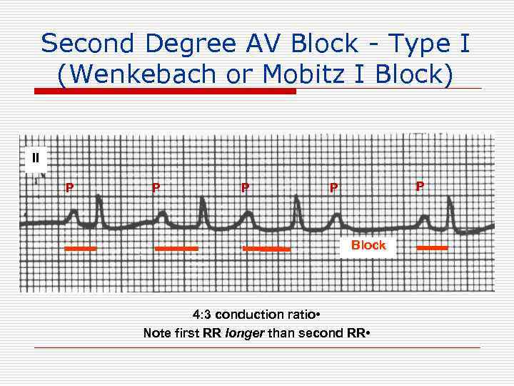 Second Degree AV Block - Type I (Wenkebach or Mobitz I Block) II P