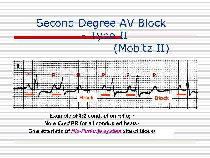 Second Degree AV Block - Type II (Mobitz II) II P P P Block