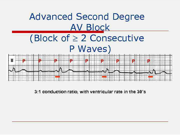 Advanced Second Degree AV Block (Block of 2 Consecutive P Waves) II P P