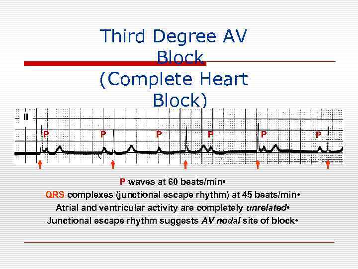 Third Degree AV Block (Complete Heart Block) II P P P waves at 60