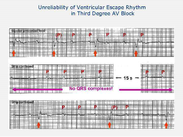Unreliability of Ventricular Escape Rhythm in Third Degree AV Block (P) P P P
