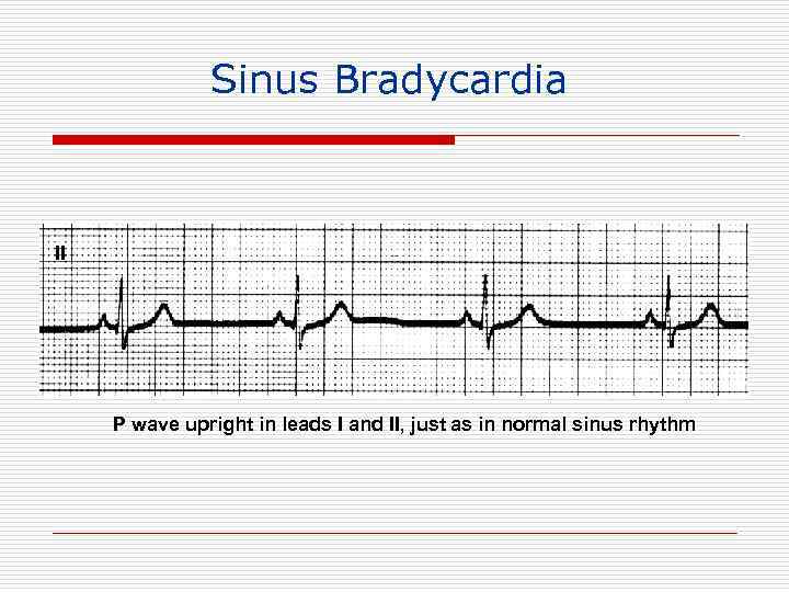 Sinus Bradycardia II P wave upright in leads I and II, just as in