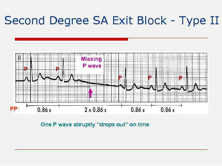 Second Degree SA Exit Block - Type II P P Missing P wave P