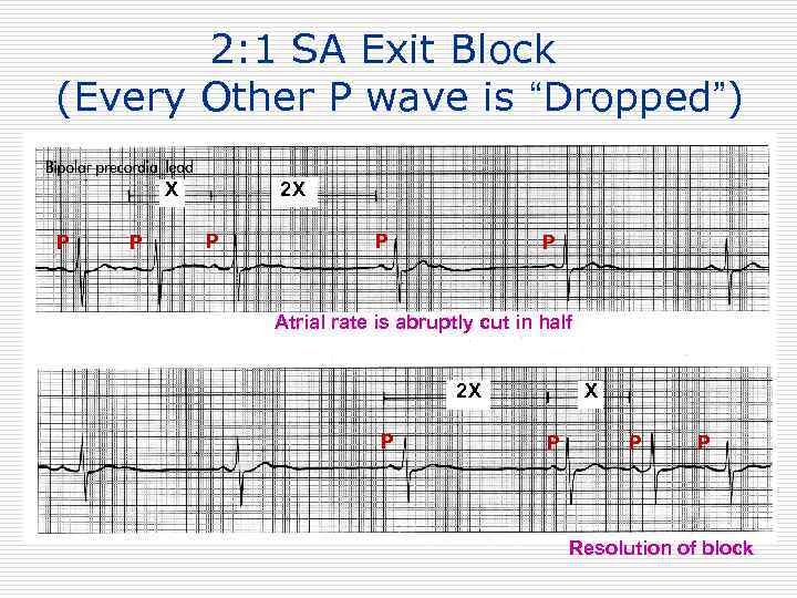 2: 1 SA Exit Block (Every Other P wave is “Dropped”) X P P