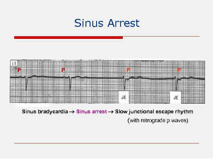 Sinus Arrest P P P’ P’ Sinus bradycardia Sinus arrest Slow junctional escape rhythm