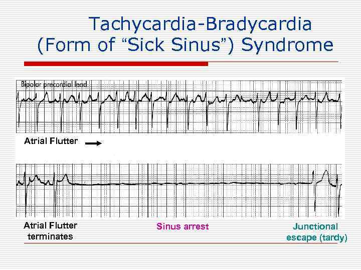 Tachycardia-Bradycardia (Form of “Sick Sinus”) Syndrome Atrial Flutter terminates Sinus arrest Junctional escape (tardy)
