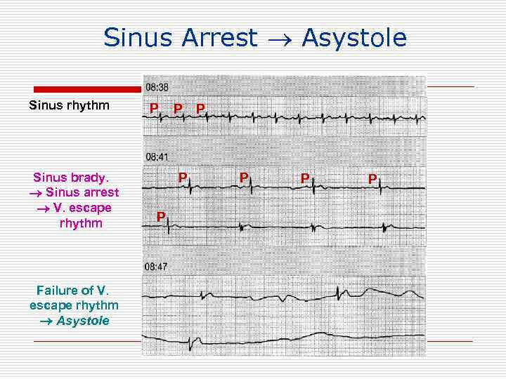 Sinus Arrest Asystole Sinus rhythm Sinus brady. Sinus arrest V. escape rhythm Failure of
