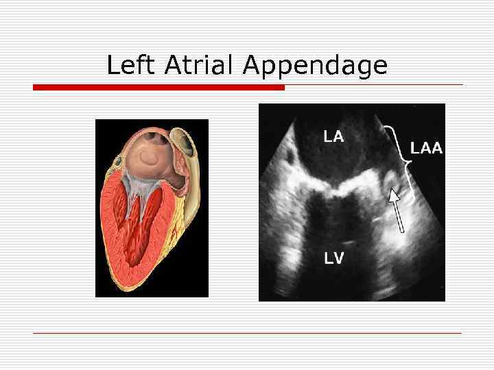 Left Atrial Appendage 