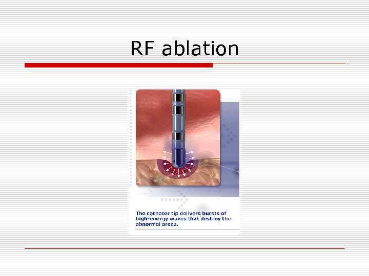 RF ablation 